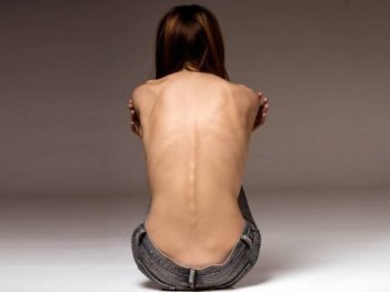 Anorexia