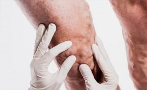 Are varicose veins hereditary?