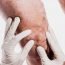 Are varicose veins hereditary?