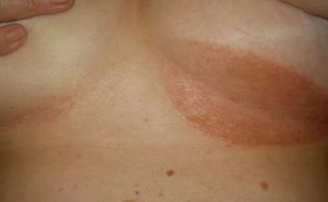 Can anybody suffer from cancer around nipples. I have brown, scab-like blemishes on and around my nipples.