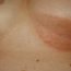 Can anybody suffer from cancer around nipples. I have brown, scab-like blemishes on and around my nipples.