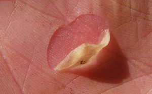 Can I burst the blister?