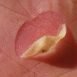 Can I burst the blister?