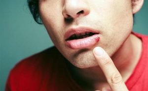 Can I get cold sores if I diet?