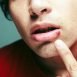 Can I get cold sores if I diet?