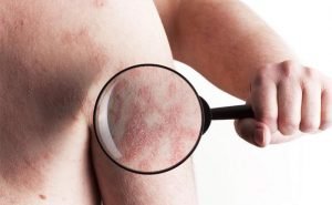 Can, psoriasis be affected by swimming?