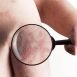 Can, psoriasis be affected by swimming?