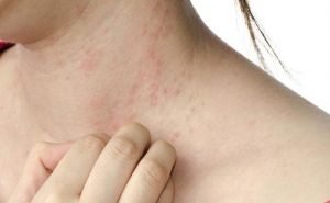 Can the change of water condition affect eczema?