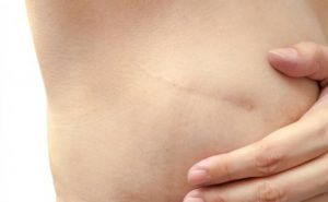 Could you please tell me what is a simple and a radical mastectomy?