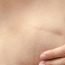 Could you please tell me what is a simple and a radical mastectomy?
