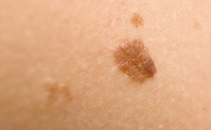 Do I need to worry because my mole seems to be growing bigger?