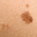 Do I need to worry because my mole seems to be growing bigger?