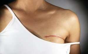 Doctors have told me that after mastectomy, breast reconstruction will be done. What is it ?