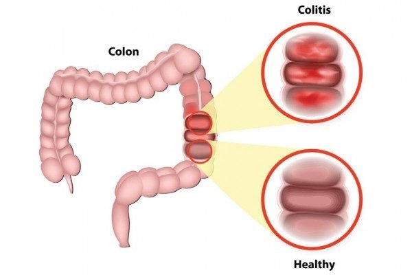 Homemade Remedies for Irritable Bowel Syndrome (IBS)