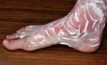 Homeopathic remedies for heat rashes