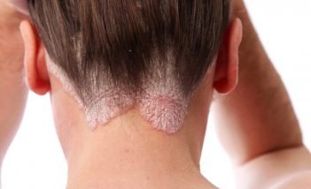 Homeopathic remedies for the treatment of psoriasi