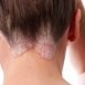 Homeopathic remedies for the treatment of psoriasi