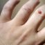 How are warts treated?