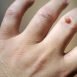 How are warts treated?
