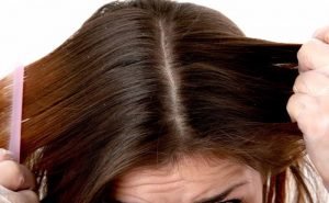 How can I get rid of dandruff?