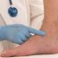 How can I prevent varicose veins?