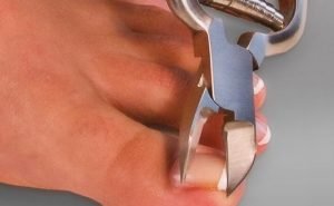 How can in growing toe nails be avoided?