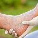 How can leg ulcer heal quickly?