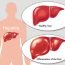 How can we differ Hepatitis A from Hepatitis B?