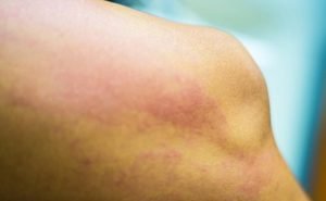 How can we know that the rashes are because of a particular thing?