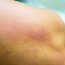 How can we know that the rashes are because of a particular thing?