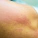 How can we know that the rashes are because of a particular thing?