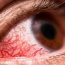How can we prevent conjunctivitis?
