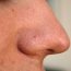 How can whiteheads be treated?
