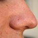 How can whiteheads be treated?