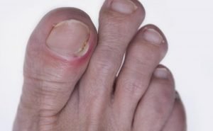 How does an ingrowing toenail occur?