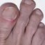 How does an ingrowing toenail occur?