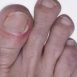 How does an ingrowing toenail occur?
