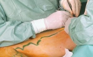 How does surgery helps in treatment of varicose veins?