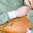 How does surgery helps in treatment of varicose veins?