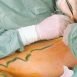 How does surgery helps in treatment of varicose veins?