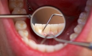 How many teeth should an adult have?