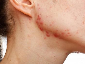 How to Cure Acne Scars at Home Naturally?