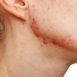 How to Cure Acne Scars at Home Naturally?