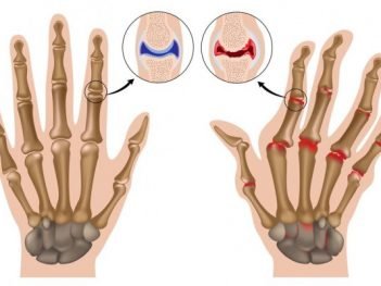 How to Cure Arthritis at Home Naturally?