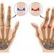 How to Cure Arthritis at Home Naturally?