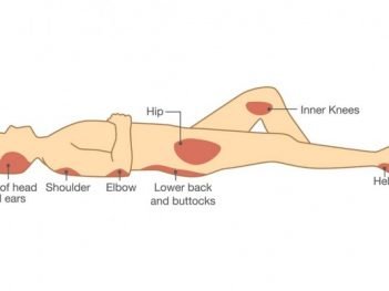 How to Cure Bed Sores at Home Naturally?