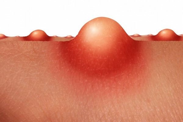 How to Cure Boils at Home Naturally?