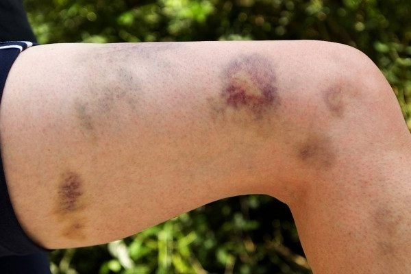 How to Cure Bruises at Home Naturally?