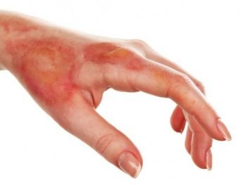 How to Cure Burns at Home Naturally?