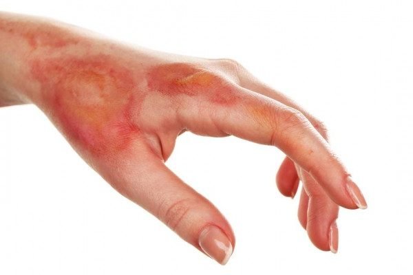 How to Cure Burns at Home Naturally?